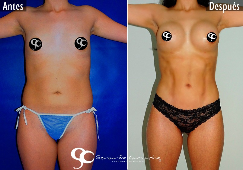 Testimonio Lipoescultura Colombia